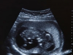 Florida Wants Women To View Ultrasound Before An Abortion