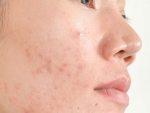 Hormonal Acne and How It is Treated