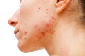 Causes of Hornomal Acne